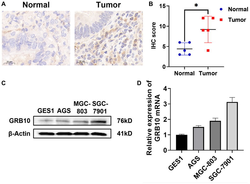 Expression of GRB10 in human gastric cancer cell lines and tissues. (A) Typical immunohistochemistry of GRB10 in gastric cancer samples. (B) IHC staining score of GRB10 in gastric cancer samples. (C) The expression of GRB10 in gastric cancer cell lines was detected by Western Blot. (D) The relative expression of GRB10 mRNA in gastric cancer cell lines was detected by qRT-PCR.