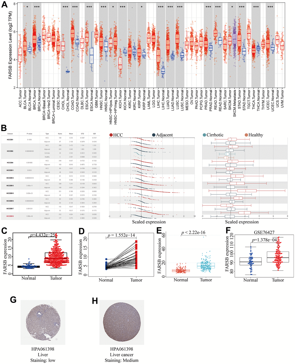 Expression of FARSB in HCC. (A) The expression level of FARSB in different types of tumor tissues and normal tissues in the TIMER database (p B) Expression levels of FARSB in HCC tissues and adjacent by HCCDB datasets. (C) Expression levels of FARSB were higher than corresponding normal tissues in LIHC samples (TCGA-LIHC) (p=4.432e-25). (D) FARSB expression in 50 paired LIHC tissues and corresponding adjacent non-tumor tissues (TCGA-LIHC) (p=1.552e-14). (E) Expression levels of FARSB were higher than corresponding normal tissues in LIHC samples by using ICGC-LIRI-JP liver datasets (pF) Expression levels of FARSB were higher than corresponding normal tissues in LIHC samples by using GEO GSE76427 liver cancer survival datasets (p=1.376e-04). (G, H) FARSB protein expression in normal and LIHC tissues (HPA).