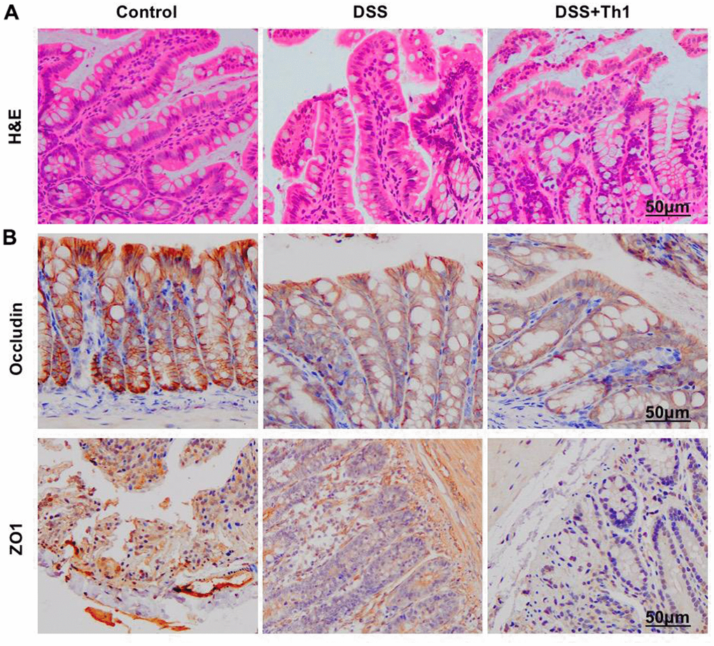 Effect of Th1 on the intestinal tissue pathology of mice. (A) H&E (n=5). Apparent inflammatory injury occurred in intestinal tissue of DSS group, along with evident goblet cell injury, while Th1 aggravated the injury and further destroyed the intestinal mucosal structure. (B) IHC (n=5). In TJ protein staining, the levels of ZO1 and Occludin significantly decreased, and Th1 further suppressed the expression of TJ proteins, and the difference was significant compared with DSS group.