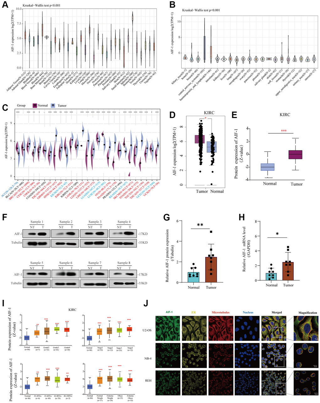 Basic information of AIF-1. (A) AIF-1 expression in 31 types of tissues. (B) AIF-1 expression in the cancer cell lines. (C) The level of AIF-1 expression between tumor and normal tissues in each type of cancer is based on the integrated data from TCGA and GTEx datasets. (D) The expression level of AIF-1 between KIRC and normal tissues. (E) The protein expression level of AIF-1 between tumor and normal tissues. (F and G) Determination and quantification of AIF-1 expression levels in KIRC tissues and paired normal tissues by western blotting assay. Tubulin was used as a loading control. (H) qRT-PCR analysis of AIF-1 mRNA expression in KIRC tumors and paired normal tissues. (I) AIF-1 expression levels in different pathologic grades, TNM stages, age phases, and body weights. (J) The immunofluorescence images of AIF-1 protein, nucleus, endoplasmic reticulum (ER), microtubules, and the incorporative images in U2-OS, NB-4, and REH cell lines. (*P **P ***P 