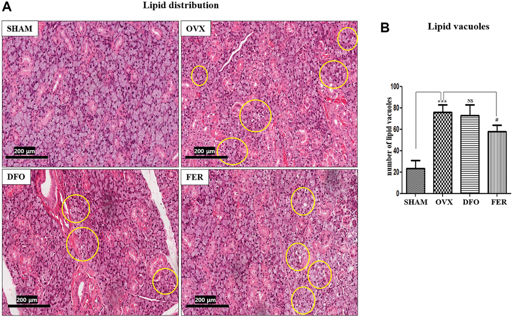 Lipid deposition in the submandibular gland. (A) Lipid deposition in the submandibular gland (H&E staining, 40×). Yellow circles indicate lipid vacuoles. The lipid distribution increased in the OVX group and decreased in the FER group, but there was no significant difference in the DFO group. (B) Morphometric analysis of lipid vacuoles in the SHAM, OVX, DFO, and FER groups. Lipid vacuoles were significantly increased in the OVX group than in the SHAM group. The FER group exhibited decreased lipid vacuoles compared with the OVX group. Two-way ANOVA was performed. ***p #p 