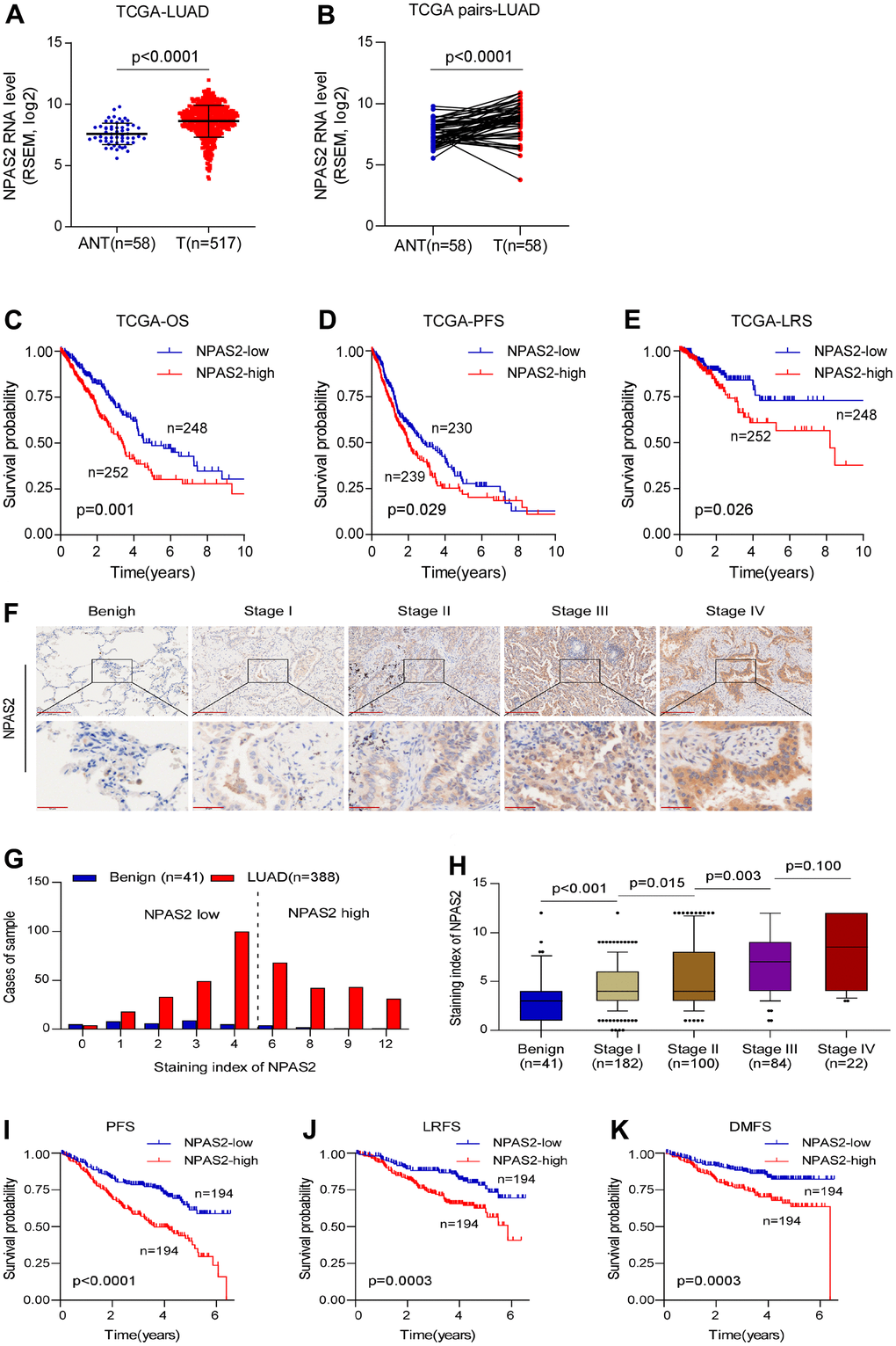 NPAS2 was associated with prognosis in LUAD. (A, B) NPAS2 expression levels between tumor and normal sample in TCGA; (C–E) High-expressed NPAS2 was associated with poor OS, PFS and LRS in LUAD based on TCGA; (F–H) NPAS2 expression increased with advanced stage. (I–K) High-expressed NPAS2 was associated with poor PFS, LRS and DMFS of LUAD patients in an independent cohort.