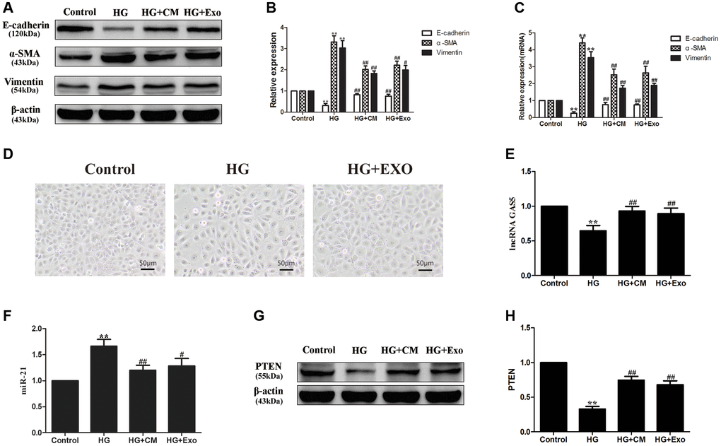 hUC-MSCs-CM alleviating EMT of HPMCs stimulated by HG through exosomes. (A) HG stimulation induced EMT of HPMCs, the hUC-MSC-CM mainly alleviated EMT through exosomes by Western Blot. (B) Statistical results of EMT changes after HG and hUC-MSCs/hUC-MSCs exosomes treatment. (C) The expression of EMT markers was detected by real-time PCR in HPMCs. (D) Treatment with hUC-MSCs exosomes effect cell morphology in HG-treated HPMCs. (E) The expression of lncRNA GAS5 was detected by real-time PCR. (F) The expression of miR-21 was detected by real-time PCR. (G, H) The expression of PTEN was detected by Western Blot. Each value represents the mean ± SEM (n = 3) (**P ##P #P 