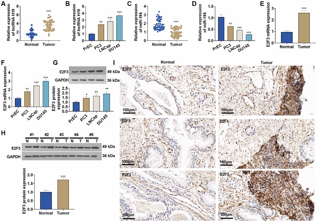 The profiles of lncRNA H19, miR-194, and E2F3 in prostate cancer tissues and cell lines. (A, B) qRT-PCR detected lncRNA H19 expression in prostate cancer tissues and cell lines. (C, D) qRT-PCR determined miR-194 expression in prostate cancer tissues and cell lines. (E, F) qRT-PCR examined E2F3 mRNA expression in prostate cancer tissues and cell lines. (G, H) Western blot was performed for assaying E2F3 protein level. (I) Immunohistochemistry checked E2F3 expression in prostate cancer tissues. Scale bar = 50 μm. *P **P ***P n = 3.