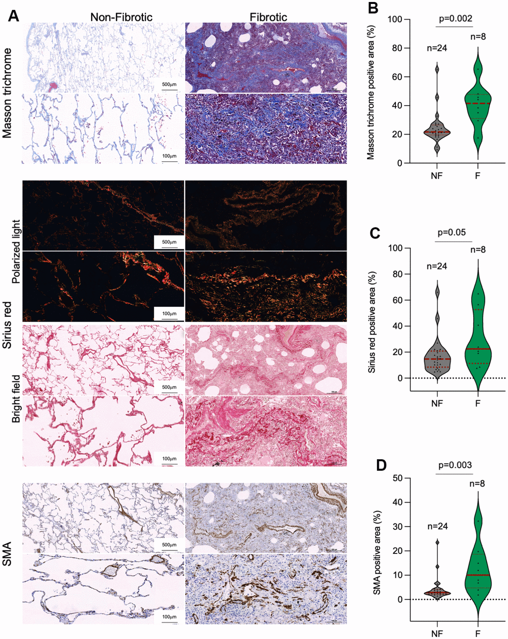 Collagen depots in patients diagnosed with lung fibrosis post-surgery. (A) Representative images of Masson trichrome, Sirius red (polarized light and bright field) and smooth muscle actine (SMA) staining in non-fibrotic and fibrotic lungs. (B–D) Quantification of Masson trichrome (B), Sirius red (C) and SMA (D) positive stained lung area in non-fibrotic (NF) and fibrotic (F) lung samples. The samples analyzed correspond to Control 1-23 and COVID-19 1-9 (Table 1). Statistical significance was assessed using Student’s t test and the p-value is indicated.