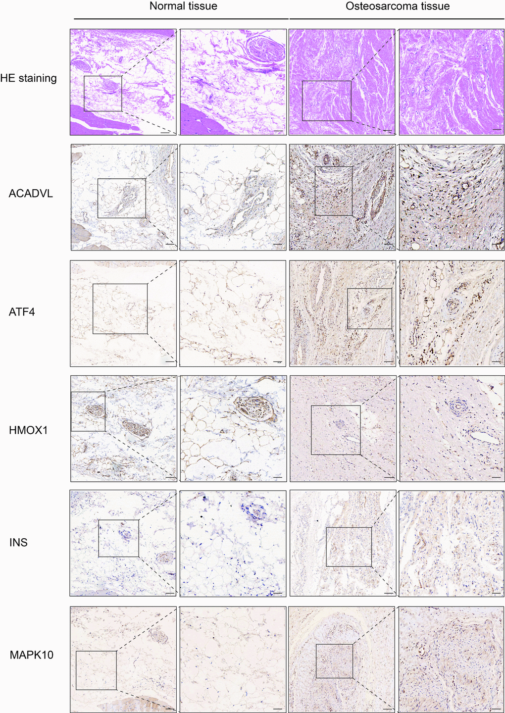 Hematoxylin eosin (HE) staining and immunohistochemistry (IHC) staining of normal and osteosarcoma tissue. Scale bar, 100 μm (left panel) and 50 μm (right panel).