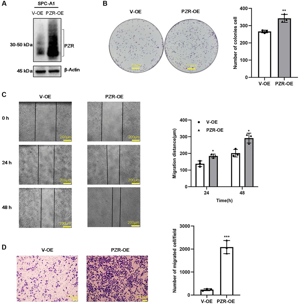 PZR overexpression promotes proliferation, migration, and invasion of SPC-A1 cells. SPC-A1 cells were infected with recombinant lentiviruses carrying PZR (PZR-OE) or the empty vector (V-OE), and stable cells were selected by treatment with puromycin. (A) Western blotting verified overexpression of PZR. (B) PZR-OE SPC-A1 cells showed increased colony-forming ability. (C) Wound healing assays demonstrated accelerated migration of PZR-OE SPC-A1 cells. Images showed the wounded monolayers of V-OE and PZR-OE SPC-A1 cells at 0 h, 24 h and 48 h (magnification, ×40). (D) Transwell invasion assays with Matrigel revealed enhanced penetration ability of PZR-OE SPC-A1 cells (magnification, ×100). All assays were done in triplicates. Data in bar graphs represent mean ± SD (n = 3). *P **P ***P 