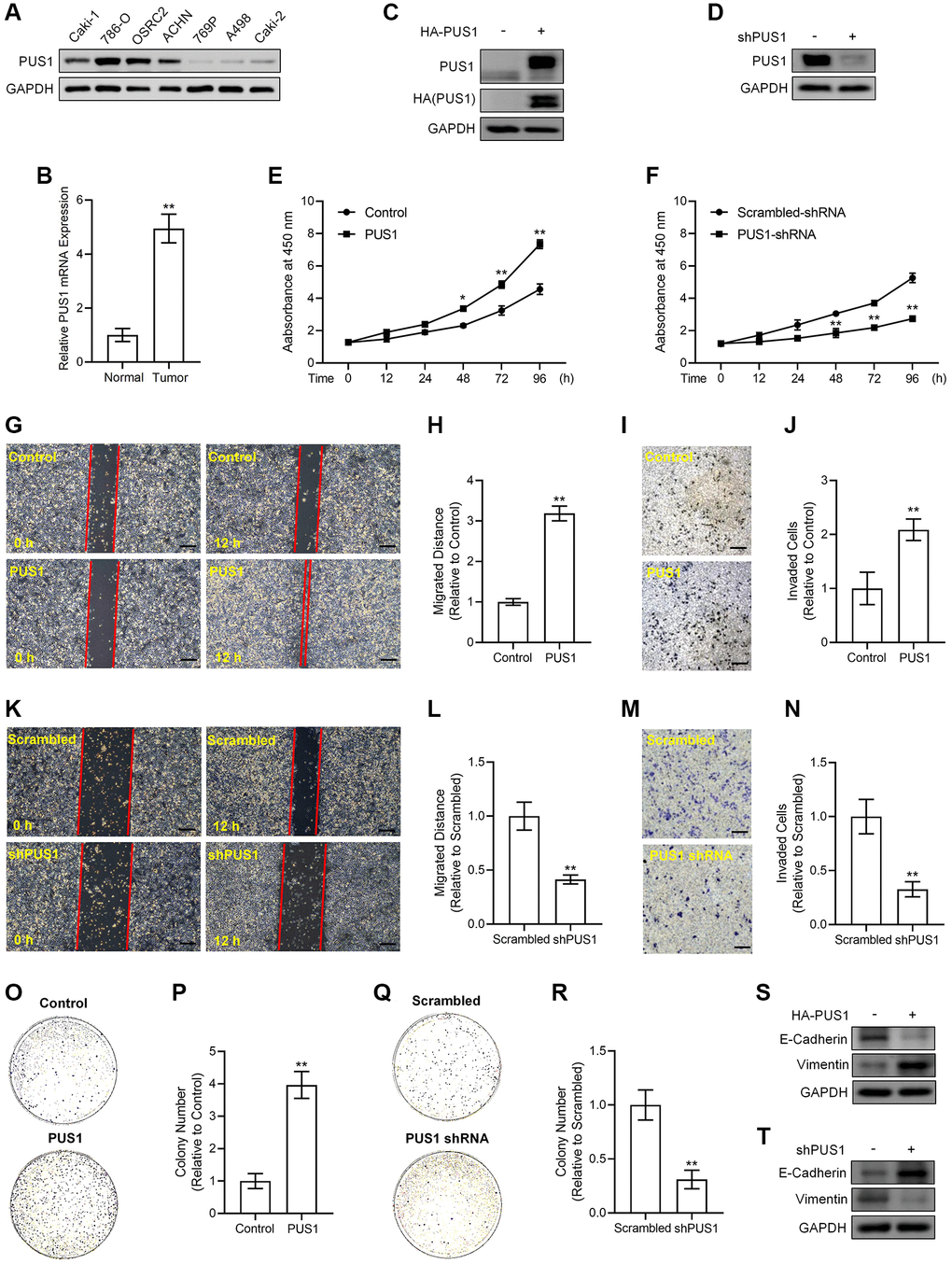 Alterations in PUS1 expression affects A498 cell and ACHN cell viability, migration, invasion, colony formation, and the expression of E-Cadherin and Vimentin. (A) The protein expression of PUS1 in different RCC cell lines. (B) The mRNA expression levels of PUS1 in cancer tissues and adjacent normal epithelial tissues from patients with RCC. N = 10. (C) A498 cells are infected with PUS1-LV and PUS1 expression was detected by western blot. (D) ACHN cells are infected with PUS1-shRNA-LV and PUS1 expression was detected by western blot. (E) A498 cells are infected with PUS1-LV and cell viability was measured. (F) ACHN cells are infected with PUS1-shRNA-LV and cell viability was measured. (G) A498 cells are infected with PUS1-LV and cell migration was determined by wound healing assay. (H) Quantitative statistics of (G). (I) A498 cells are infected with PUS1-LV and cell invasion was detected by matrigel-transwell assay. (J) Quantitative statistics of (I). (K) ACHN cells are infected with PUS1-shRNA-LV and cell migration was determined by wound healing assay. (L) Quantitative statistics of (K). (M) ACHN cells are infected with PUS1-shRNA-LV and cell invasion was detected by matrigel-transwell assay. (N) Quantitative statistics of (M). (O) A498 cells are infected with PUS1-LV and cell colony formation was performed. (P) Quantitative statistics of (O). (Q) ACHN cells are infected with PUS1-shRNA-LV and cell colony formation was performed. (R) Quantitative statistics of (Q). (S) Protein levels of E-Cadherin and Vimentin in A498 cells infected with PUS1-LV. (T) Protein levels of E-Cadherin and Vimentin in ACHN cells infected with PUS1-shRNA-LV. SD, error bar; **p *p 