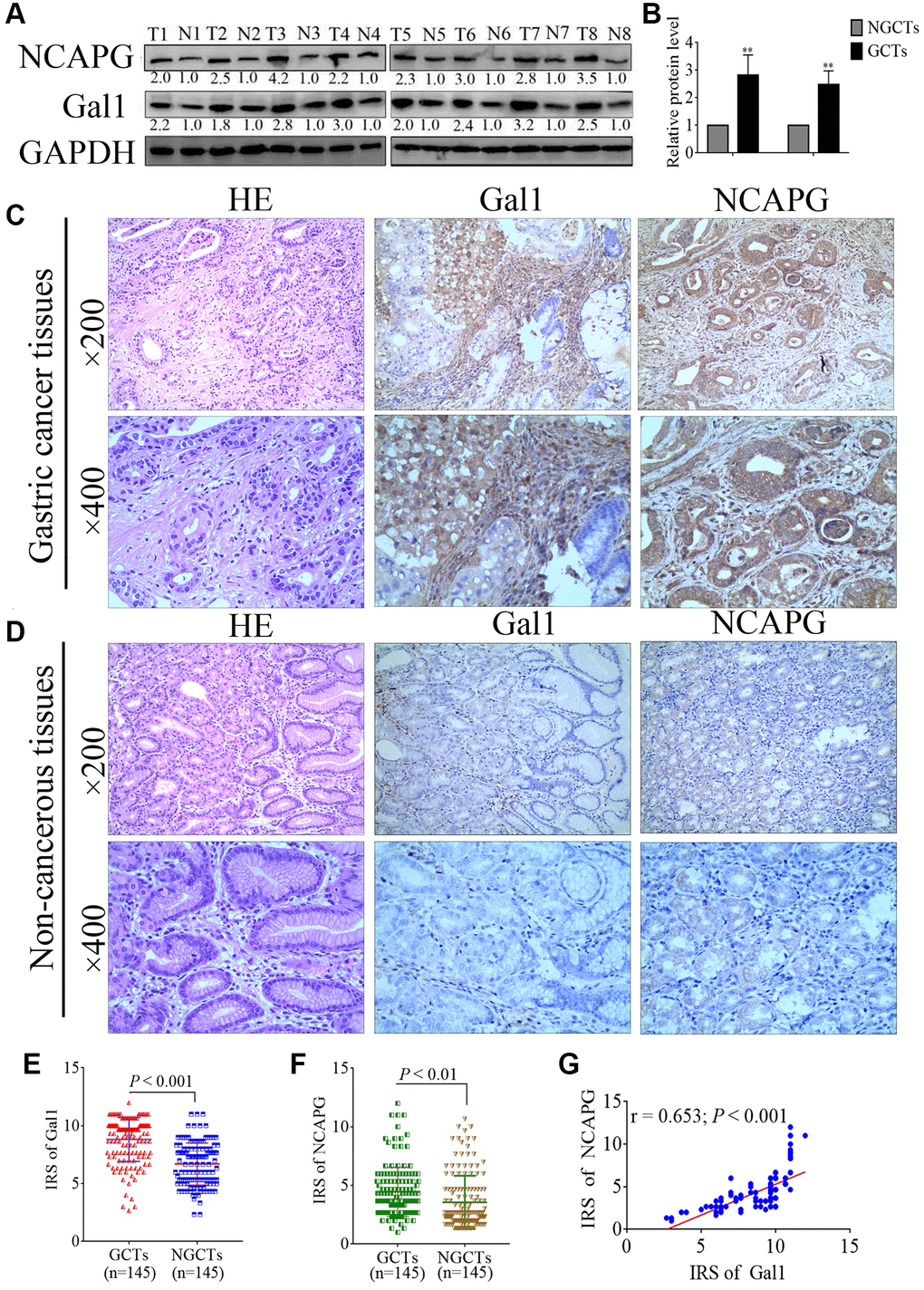 Gal1 and NCAPG expression predict prognosis of gastric cancer (GC). (A, B) Expression of Gal1 and NCAPG proteins detected by Western blotting in GC cancer tissues (GCTs) and non- gastric cancer tissues (NGCTs). (C, D) Representative immunohistochemistry images for Gal1 and NCAPG in (C) GC tissues, and (D) matched non-cancerous tissues. (E) Immunoreactivity score (IRS) for Gal1 compared between GCTs and matched NGCTs. (F) IRS for NCAPG compared between GCTs and matched NGCTs. (G) The expression of Gal1 was positively correlated with NCAPG expression in GC tissues. Abbreviations: T: tumor tissue; N: non-tumor tissue; GCTs: gastric cancer tissues; NGCTs: non- gastric cancer tissues. **P 