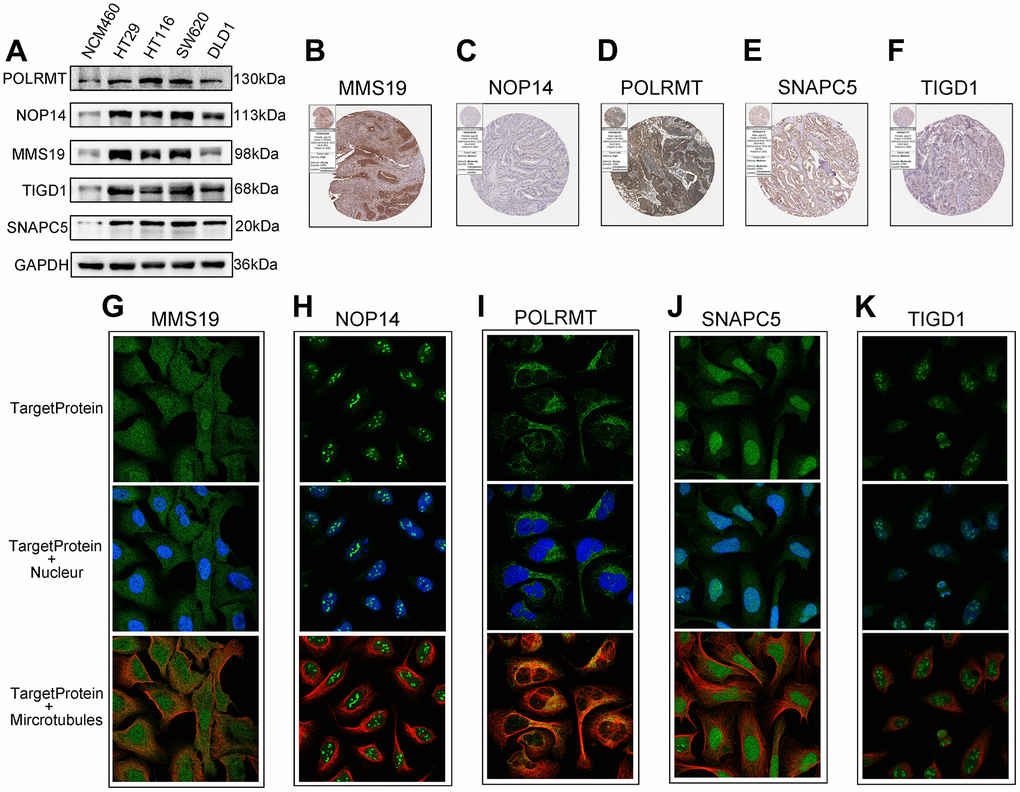 The expression of the identified five CDM genes from the human protein atlas database (HPA). (A) Western blotting. The protein expression of five CDM genes in the normal derived colon mucosal (NCM460) and colon cancer cells (HT29, HCT116, SW620 and DLD1). (B–F) Protein expressions of five CDM genes in colon cancer tissue specimens by immunohistochemical; (B) for MMS19; (C) for NOP14; (D) for POLRMT; (E) for SNAPC5; (F) for TIGD1. (G–K) Protein expressions and localization of five CDM genes in U2-OC cell by immunofluorescence (green represent five CDM-associated protein, blue represent nucleus and red represent microtubule); (G) for MMS19; (H) for NOP14; (I) for POLRMT; (J) for SNAPC5; (K) for TIGD1.