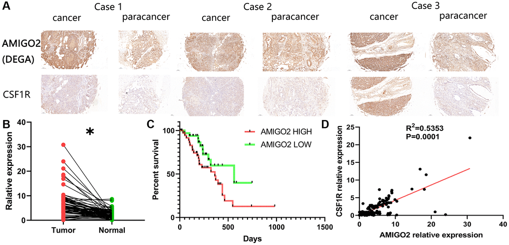 (A) Representative immunohistochemical imagines of AMIGO2 and CSF1R in caner and paracancerous tissue; *p B) The mRNA expression of AMIGO2 in caner and paracancerous tissue. (C) Survival analysis of AMIGO2. (D) The correlation between the mRNA expression of CSF1R and AMIGO2 in cancer and paracancerous tissue.