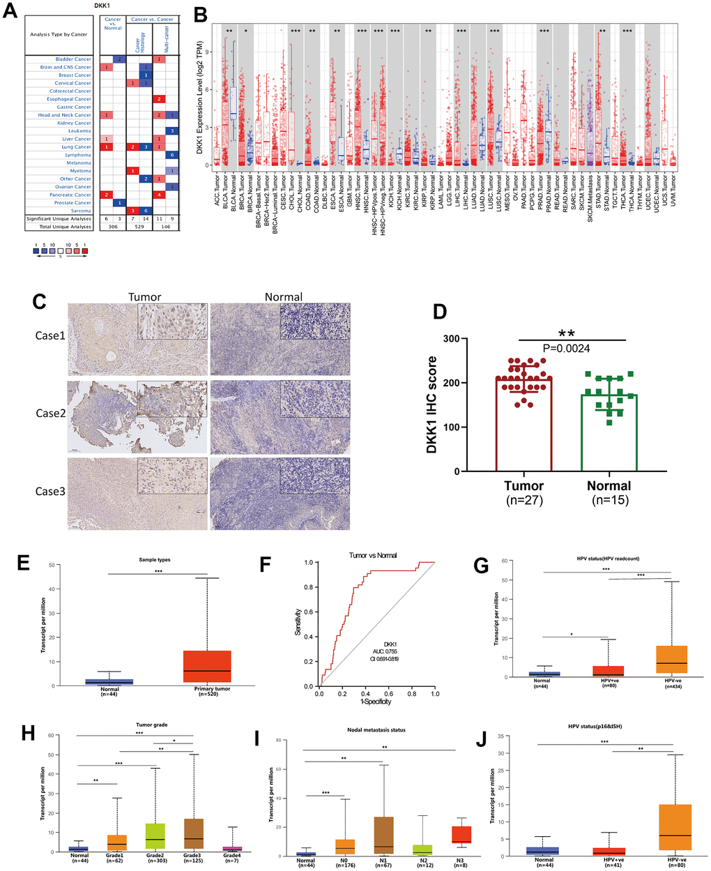 DKK1 expression in different cancers and its relationship with individual clinical characteristics of HNSCC. (A) DKK1 mRNA expression levels in different types of cancer tissues compared to that in normal tissues, based on information in the Oncomine database. (B) DKK1-expression levels in different cancers in the TIMER database. (C, D) DKK1-expression levels in representative HNSCC samples and normal tissues, as determined using IHC. The DKK1 levels were higher in HNSCC tissues than in normal tissues (P = 0.0024). (E) Differences in DKK1 expression in various HNSCC sample types, based on information deposited in the UALCAN database. (F) DKK1 exhibited a high diagnostic value for distinguishing between tumor and normal tissues. (G–J) DKK1 mRNA expression levels were remarkably correlated with the tumor grade (H), nodal-metastasis status (I), and HPV status (G, J) of patients with HNSCC, based on information from the UALCAN database (***p 