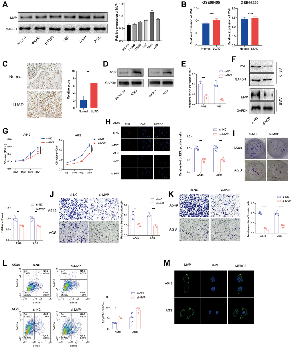 MVP knockdown effects in cancer cells. (A) The protein expression level of MVP in each cell line was tested by western blot. (B) Analysis of the GEO database showed that MVP was highly expressed in LUAD and STAD compared to adjacent tissues. (C) Immunohistochemical staining showed that MVP was highly expressed in LUAD compared with adjacent tissues. (D) Western blot assay confirmed that MVP expression was higher in A549 and AGS cells than in their corresponding normal epithelial cells. (E, F) RT-qPCR and western blot confirming MVP knockdown efficiency in A549 and AGS. (G) CCK-8 assay measuring cell proliferation in MVP-knockdown and control cells. (H) EdU assay measuring cell proliferation in MVP-knockdown and control cells. (I) Colony formation assay showed that MVP knockdown inhibits the colony formation ability of cells. (J, K) Transwell migration and invasion assays showing decreased migration and invasion of MVP-knockdown cells. (L) Cell apoptosis was monitored by flow cytometry. (M) Immunofluorescence assay showed that MVP was mainly distributed in the cell membrane and cytoplasm of A549 and AGS cells. *P **P ***P ****P 